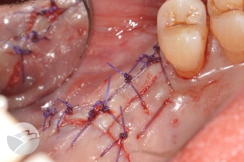 Putney-periodontics-Sydney-implant