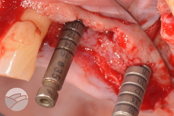 implants-Putney-periodontics-Sydney