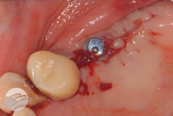 Putney-periodontics-Sydney-implant