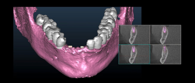 jawbone 3d imaging