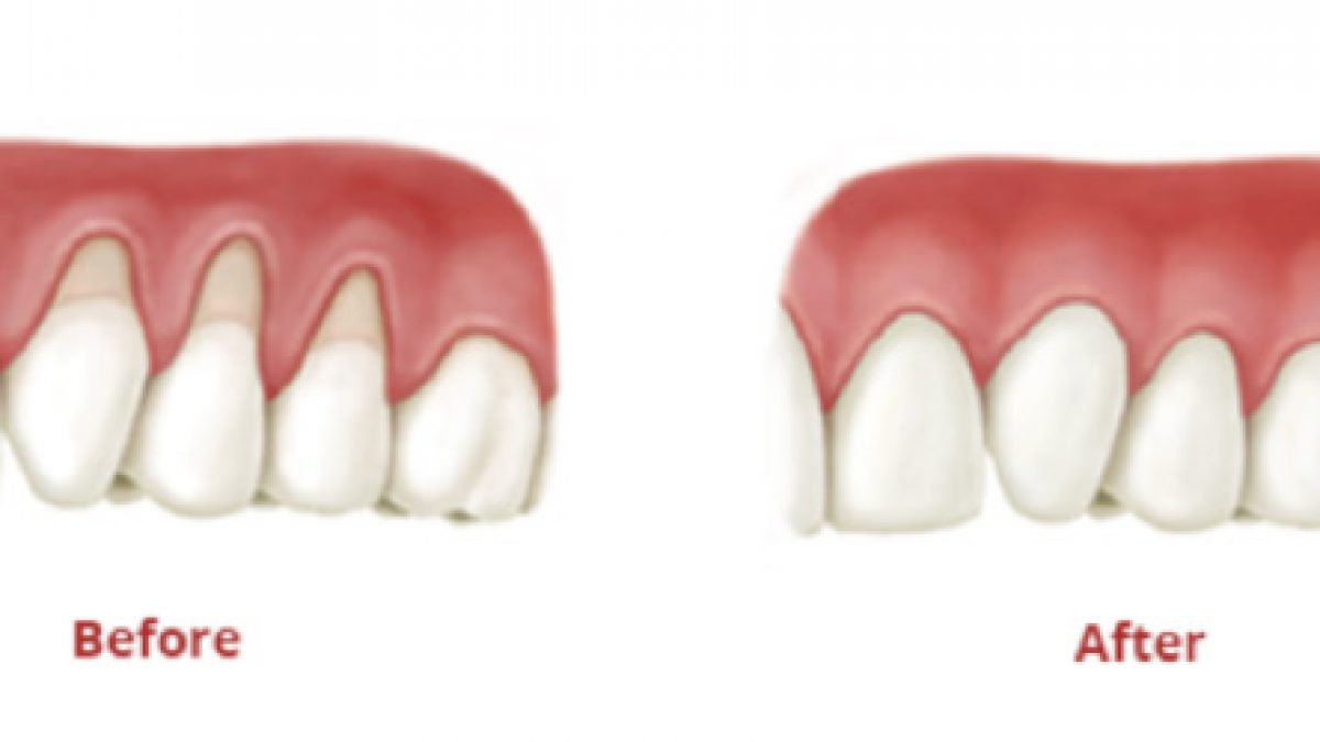 Receding Gums Before And After