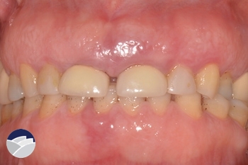 before gummy smiles treatment